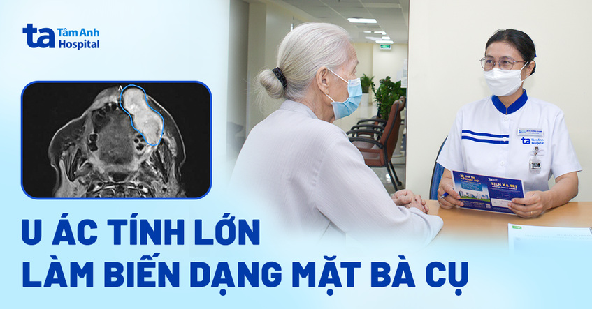 U ác tính lớn làm biến dạng mặt bà cụ