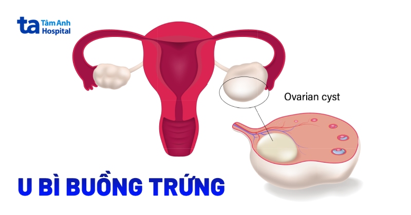 U bì buồng trứng nguy hiểm không? Có thể điều trị?