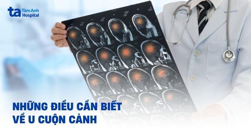 Tìm hiểu về u cuộn cảnh