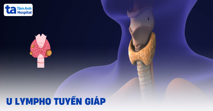 U lympho tuyến giáp là bệnh gì?