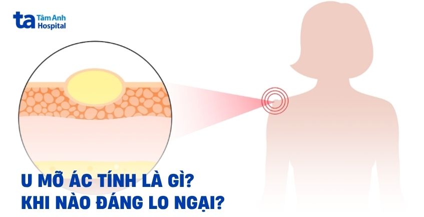 U mỡ ác tính là gì? Khi nào sẽ tiến triển đáng lo ngại?