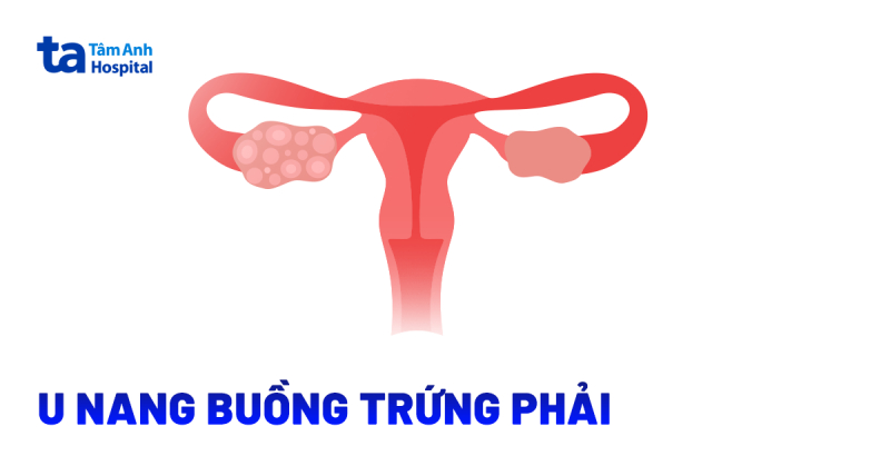 Cách điều trị u nang buồng trứng phải​ hiệu quả