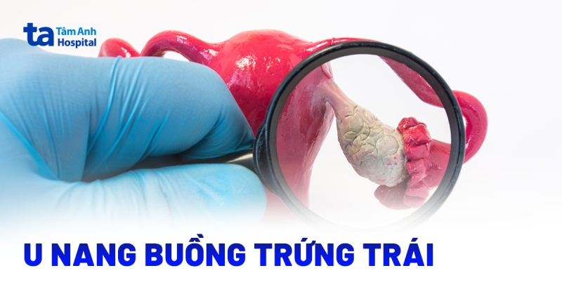 U nang buồng trứng trái có dấu hiệu nào? Làm sao để chữa?