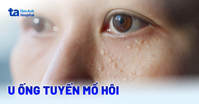 U ống tuyến mồ hôi là gì? Có nguy hiểm và lây lan không?