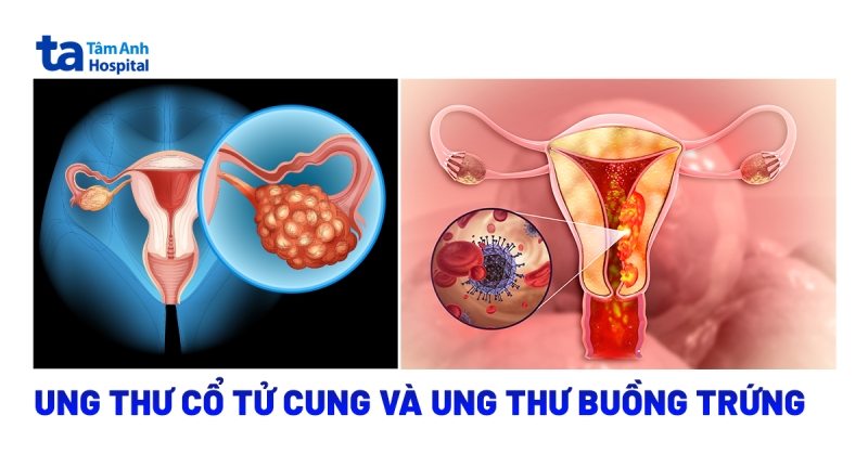 Khác biệt giữa ung thư cổ tử cung và ung thư buồng trứng