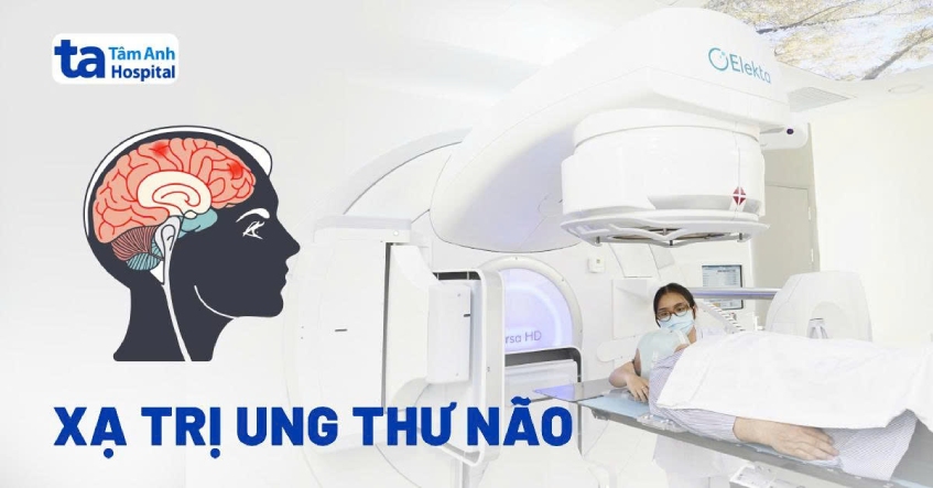 Góc thắc mắc: Ung thư não có xạ trị được không?