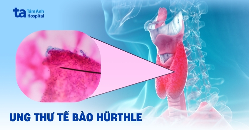 Bạn có biết gì về ung thư tế bào Hurthle không?