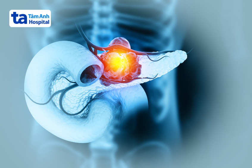 Hình ảnh khối tổn thương tụy phát sáng, minh họa ung thư tụy trong các bệnh lý tuyến tụy