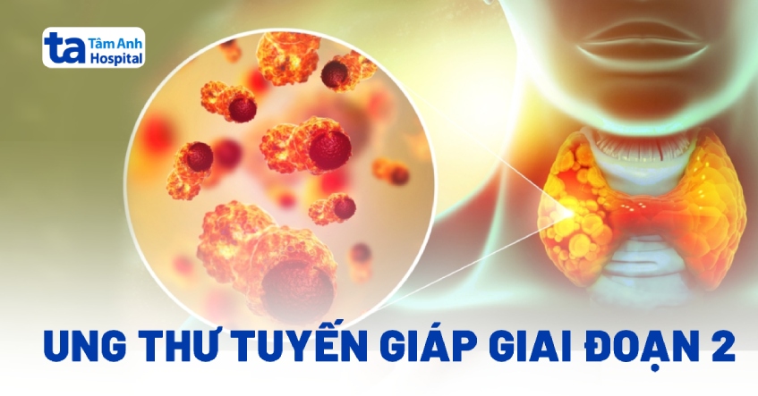 Thế nào là ung thư tuyến giáp giai đoạn 2?