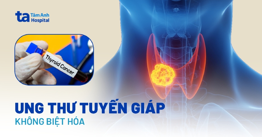 Cập nhật thông tin về ung thư tuyến giáp không biệt hóa