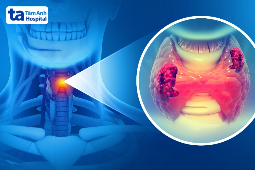 ung thư tuyến giáp thể không biệt hoá có độ ác tính cao