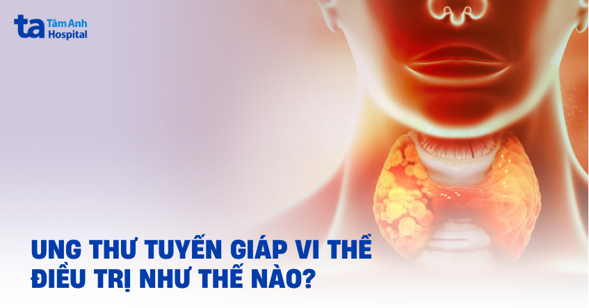 Ung thư tuyến giáp vi thể điều trị như thế nào?