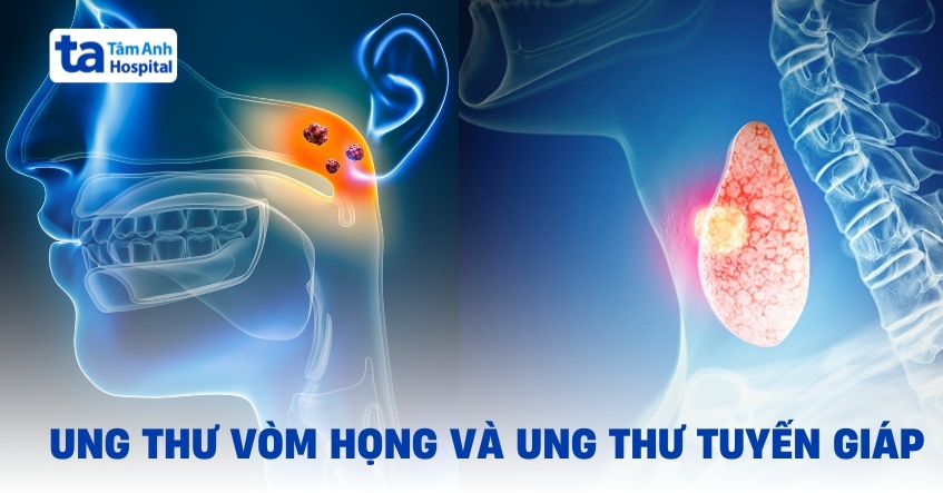 Ung thư vòm họng và ung thư tuyến giáp có gì khác nhau?