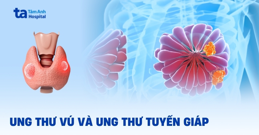 Giữa ung thư vú và ung thư tuyến giáp có mối liên hệ gì không?