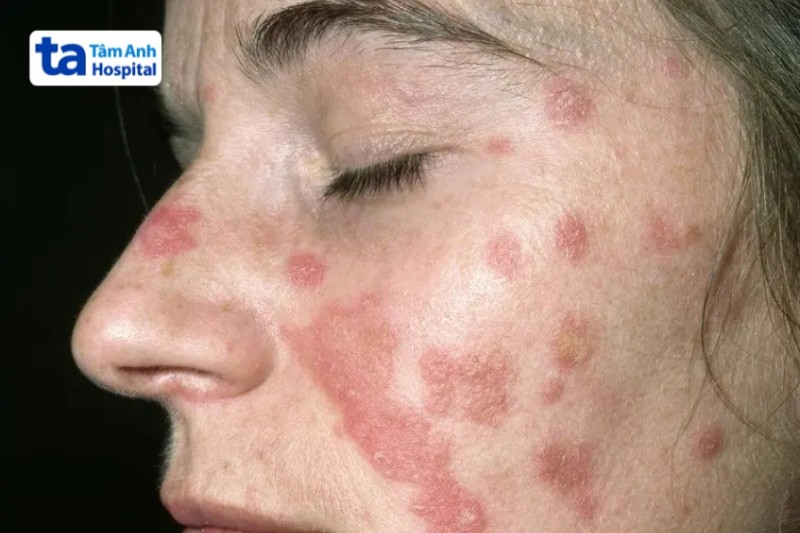 vảy nến gây nguy hiểm cho người bệnh