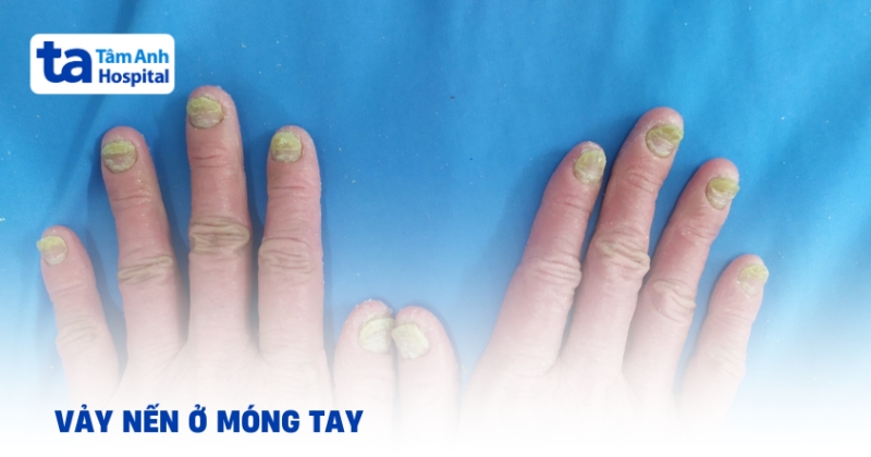 Thể vảy nến móng tay, chân làm sao để điều trị?