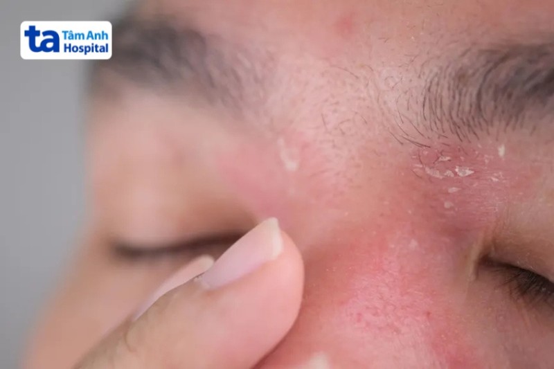 vảy nến dễ nhầm với bệnh viêm da tiết bã