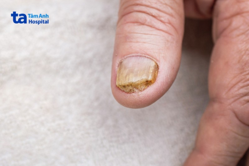 vảy nến ở móng tay