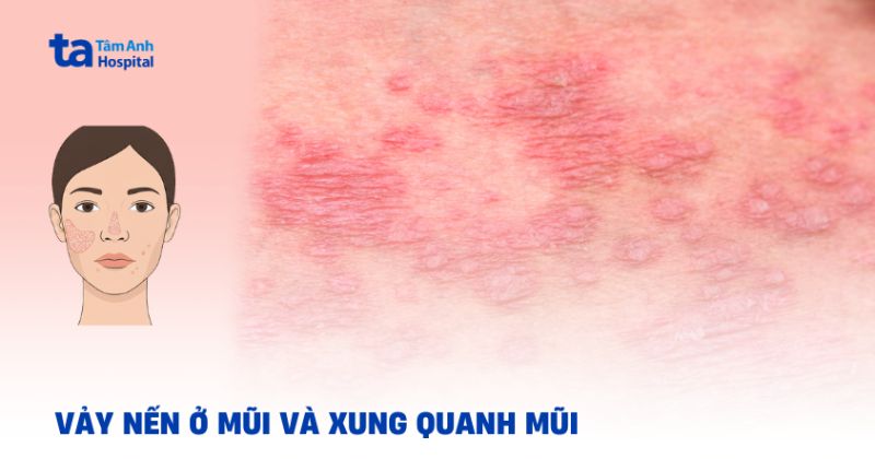 Tình trạng vảy nến ở mũi và vùng xung quanh phải làm sao?
