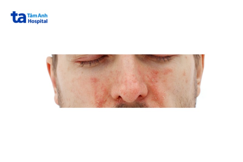vảy nến ở trên mũi và xung quanh mũi