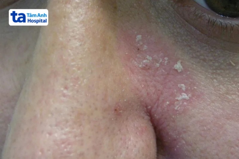 mảng da bong tróc do vảy nến