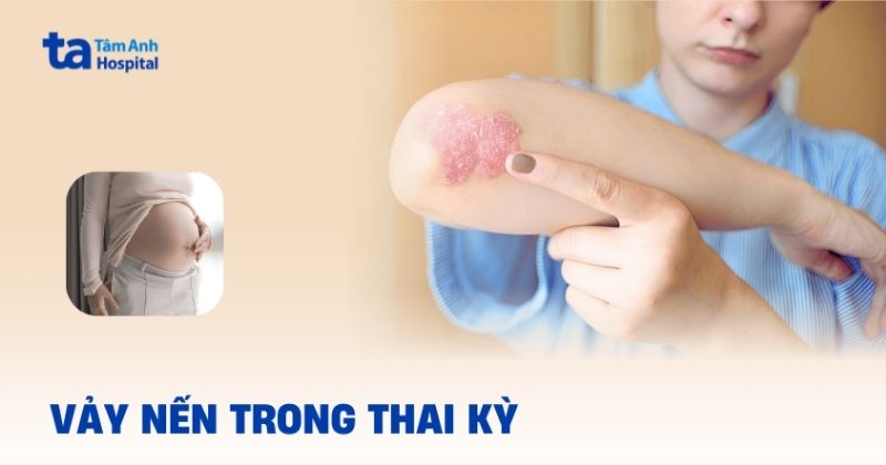 Vảy nến trong thai kỳ: Những điều mẹ cần biết