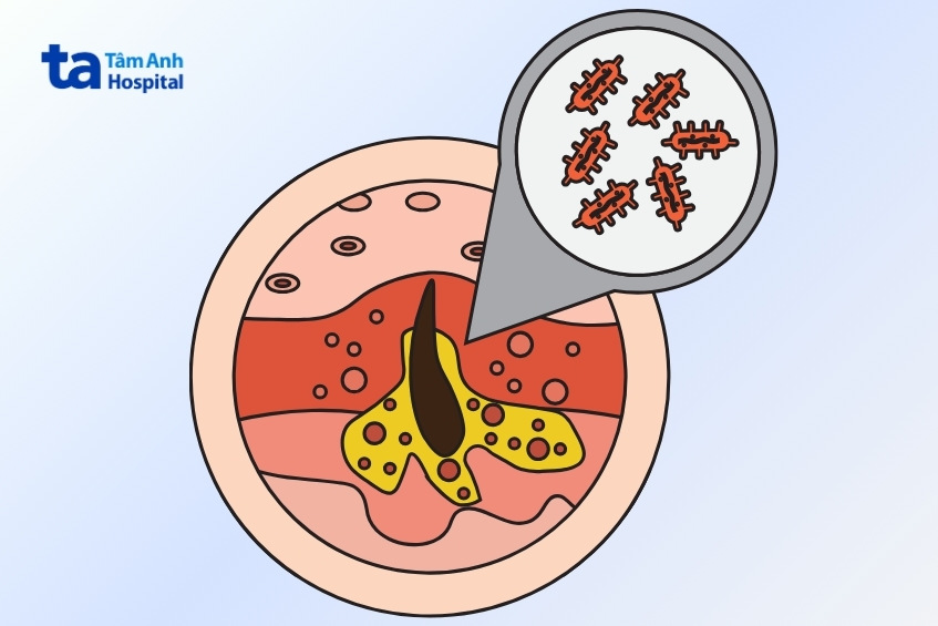 vi khuẩn cutibacterium acnes