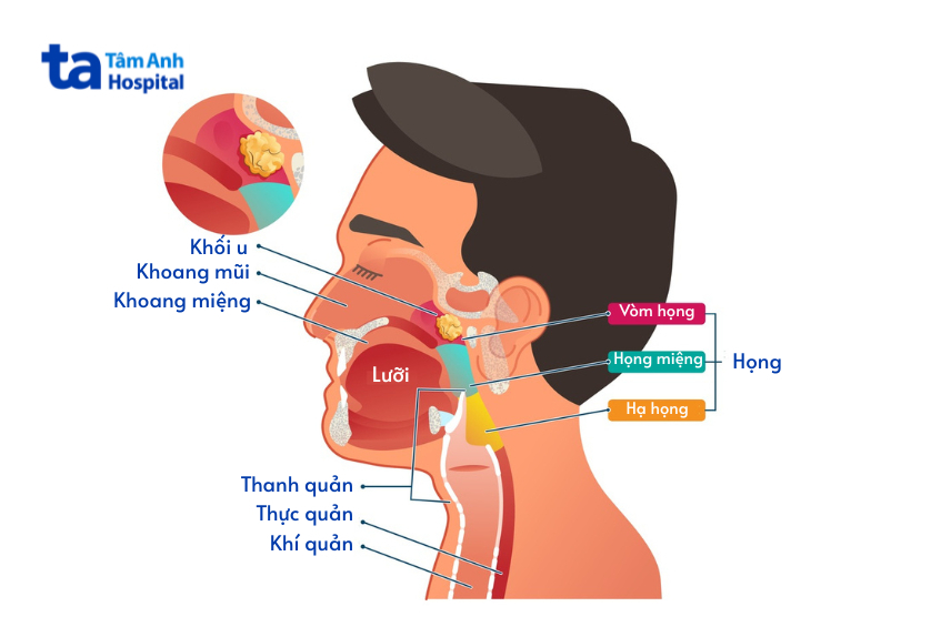 vị trí khối u ác tính vòm họng (ung thư vòm họng)