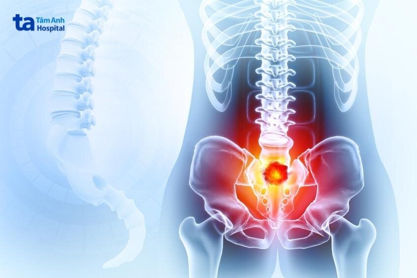 việc xạ trị giúp giảm đau