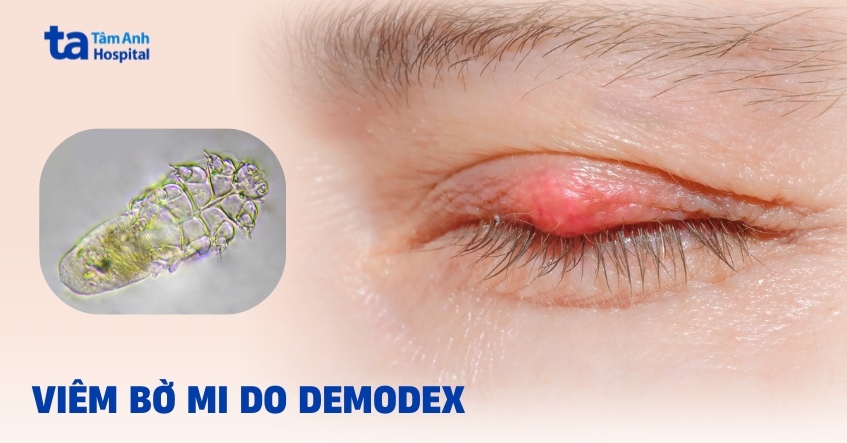 Viêm bờ mi do Demodex: Tổng quan về bệnh