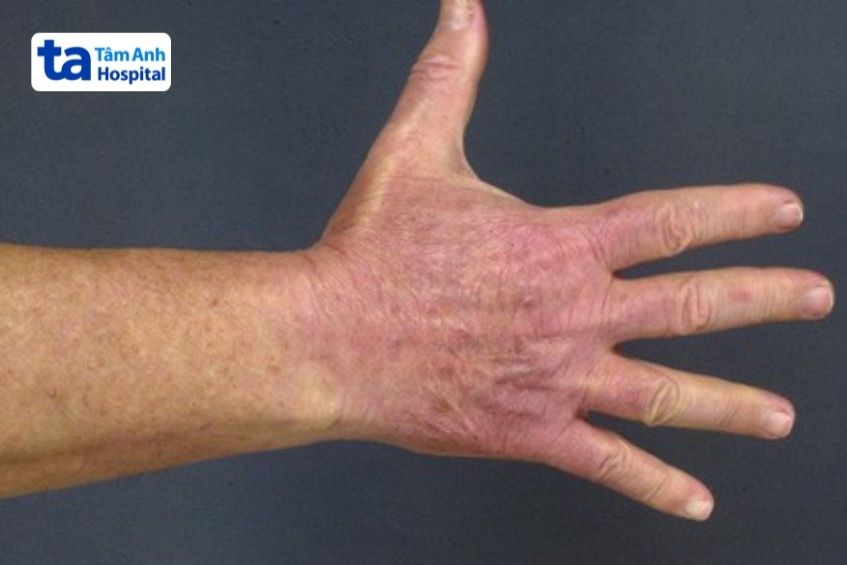 viêm da ánh nắng mặt trời