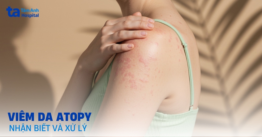 Viêm da Atopy: Nhận biết và cách xử trí