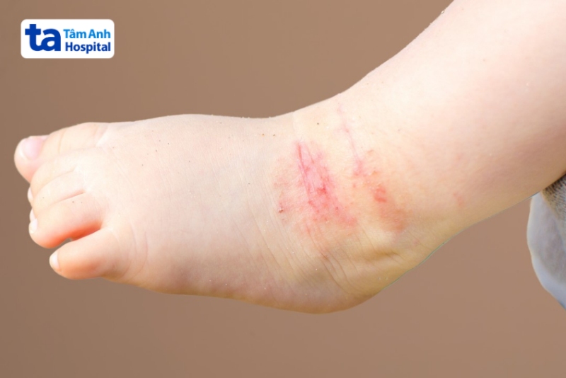 viêm da cơ địa bán cấp