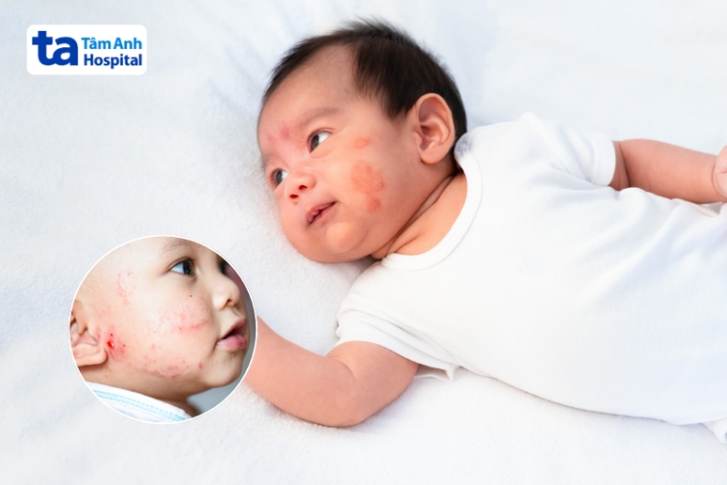 viêm da cơ địa bị rỉ dịch