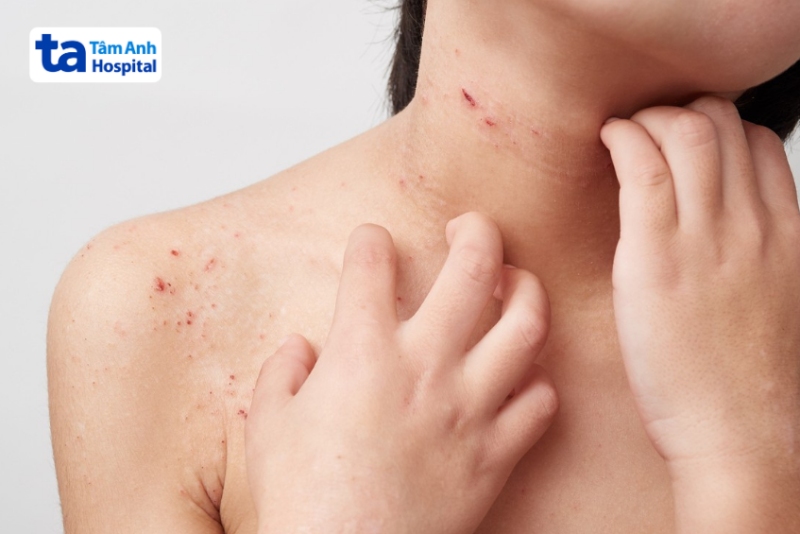 viêm da cơ địa khắp toàn thân