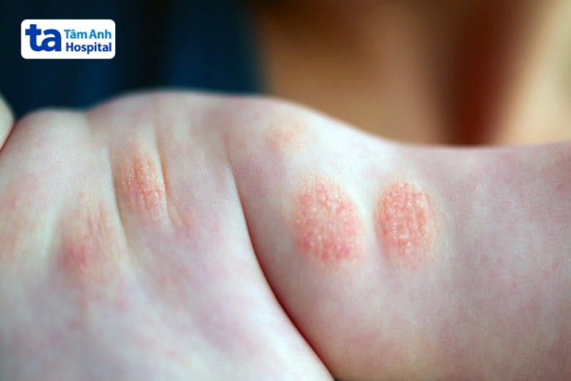 viêm da cơ địa mạn tính