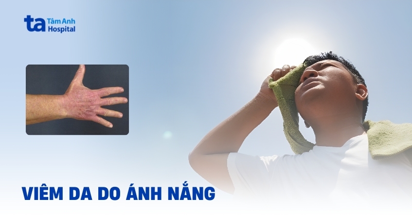 Nhận biết viêm da do ánh nắng và cách phòng tránh