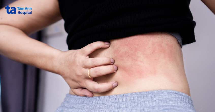 Nữ giới bị ngứa và mẩn đỏ vùng hông, dấu hiệu phổ biến của nhiễm nấm ngoài da