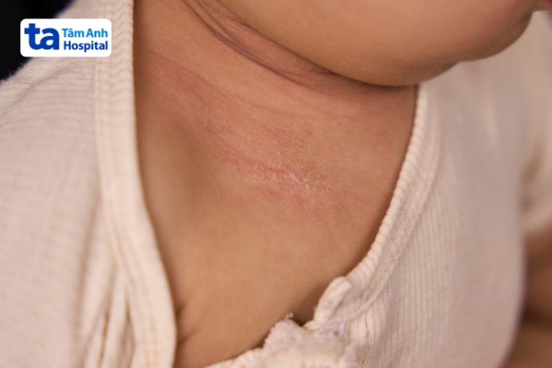 viêm da đóng vảy trắng