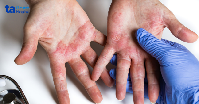 Hình ảnh viêm da lòng bàn tay mức độ trung bình, tổn thương đỏ rát cần dùng corticosteroid như betamethasone