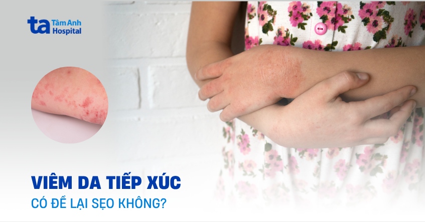 Giải thích: Bị viêm da tiếp xúc có để lại sẹo không?