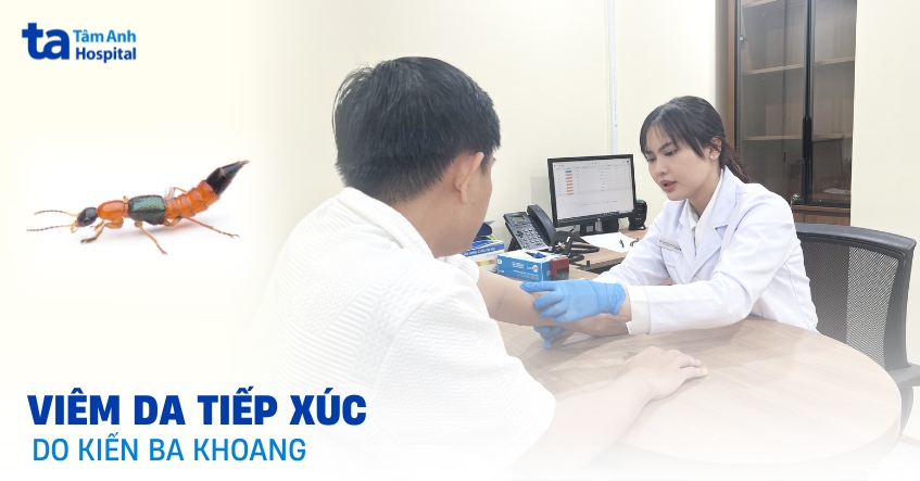 Viêm da tiếp xúc do kiến ba khoang: Cách xử lý an toàn