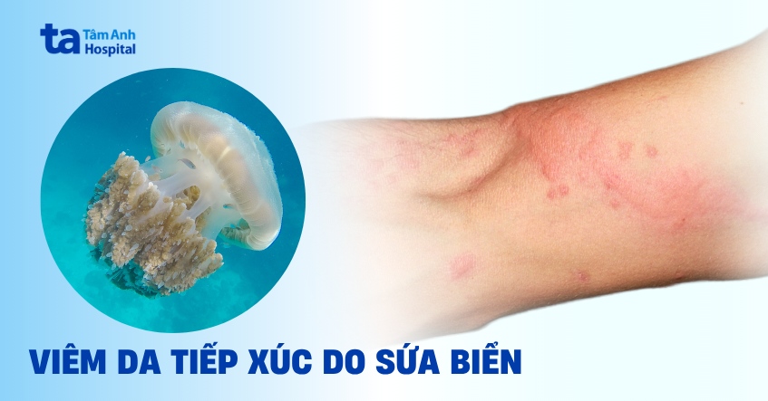 Cảnh giác viêm da tiếp xúc do sứa biển mùa du lịch