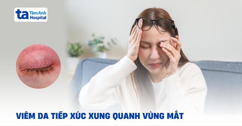 Viêm da tiếp xúc ở mí mắt: Xử lý thế nào để đảm bảo an toàn?