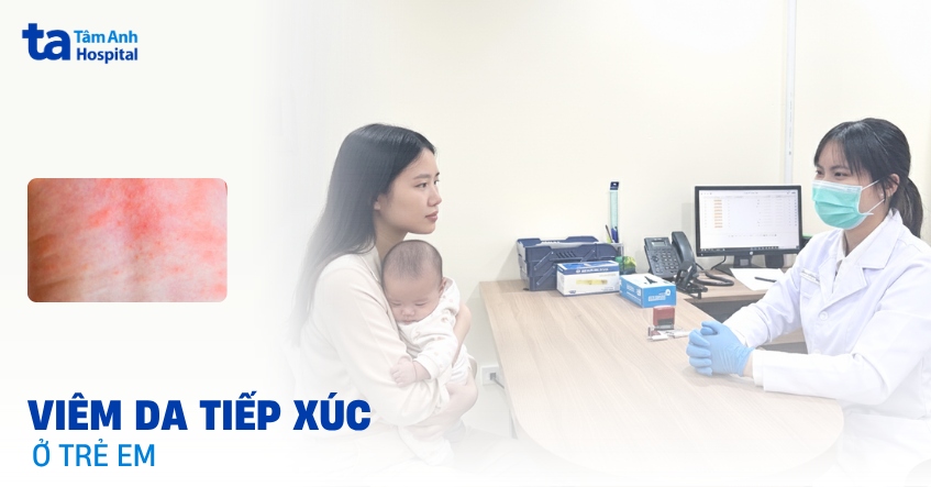 Viêm da tiếp xúc ở trẻ em: Cha mẹ bé cần lưu ý điều gì?