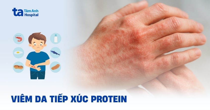 Viêm da tiếp xúc protein (PCD): Các thông tin cần biết