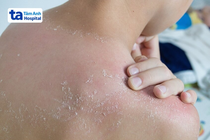 viêm da tróc vảy
