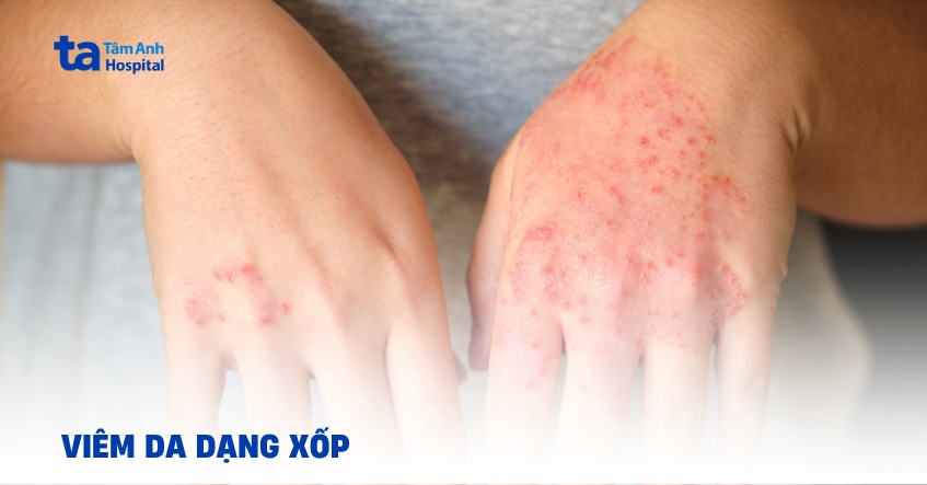 Viêm da xốp: Nguyên nhân, triệu chứng, điều trị