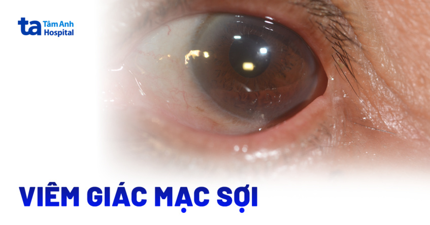 Hiểu đúng về viêm giác mạc sợi và cách điều trị hiệu quả