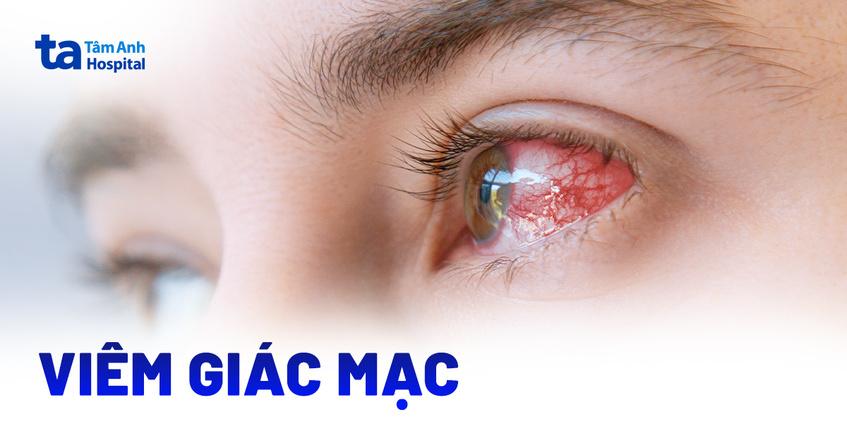 Viêm giác mạc là gì? Nguyên nhân, dấu hiệu, chẩn đoán, phòng ngừa
